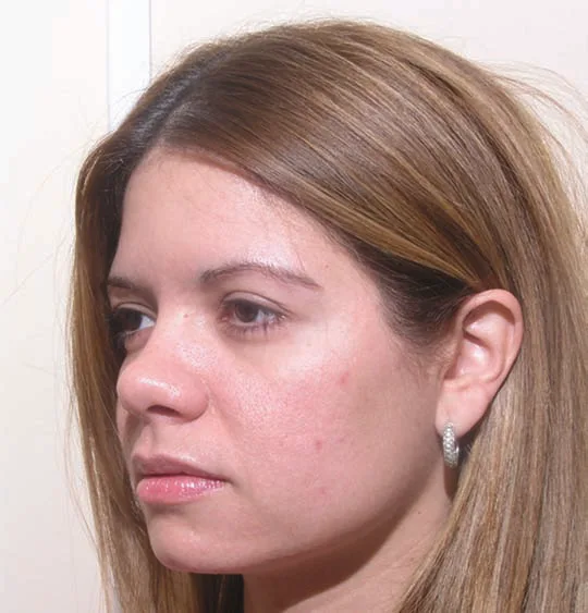 Fig 1. Oblique view of a young Hispanic/Latina woman illustrating a balanced midface with preserved malar projection and no single-canon "deficit".